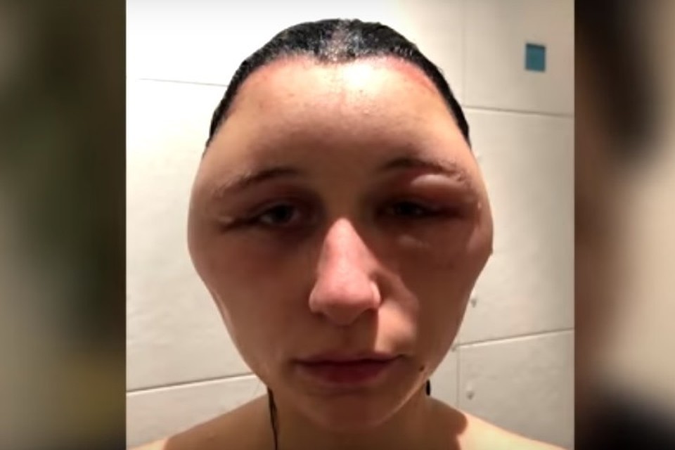 У француженки из-за краски для волос деформировалось лицо