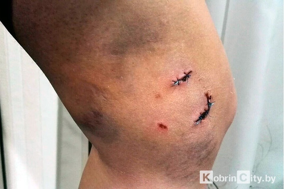 Собака искусала 14-летнюю школьницу в Кобрине. Фото: kobrincity.by