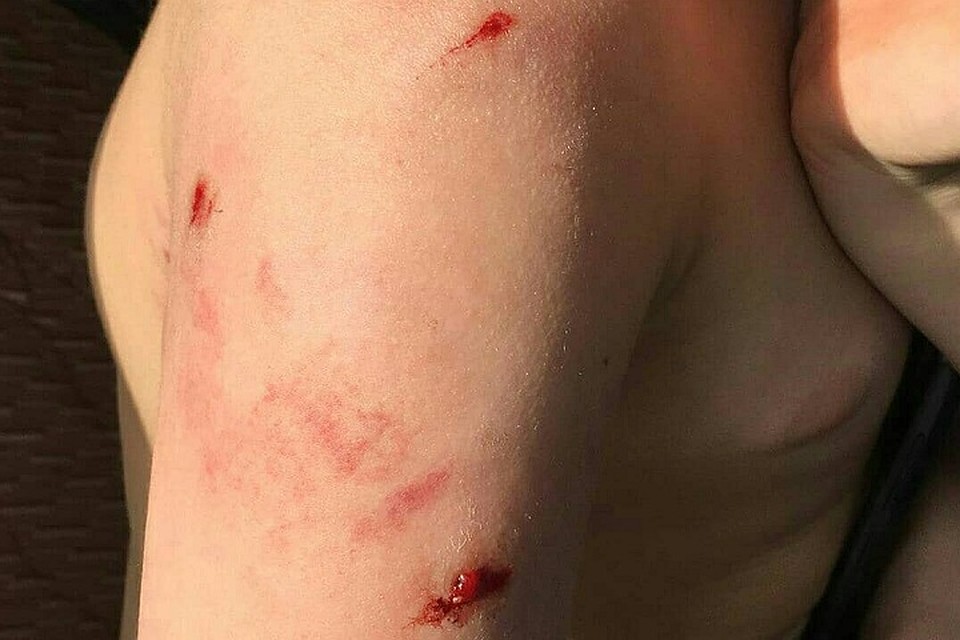 9-летний ребенок чувствует себя хорошо, но раны до сих пор не зажили\ФОТО: Инстаграм матери пострадавшего