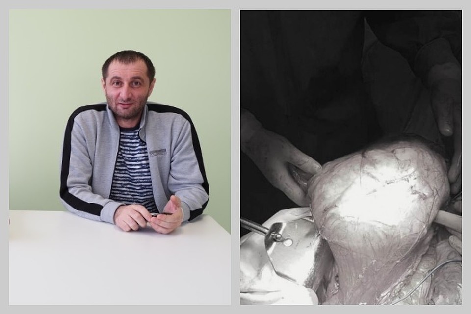 Красноярцу удалили гигантский жировик весом в 6 кг! Фото: пресс-служба краевой больницы.