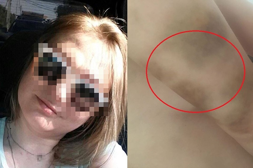 На теле девушки сейчас множество синяков. Фото: личный архив.