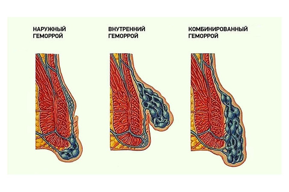 Можно ли поставить диагноз «геморрой» по симптомам?