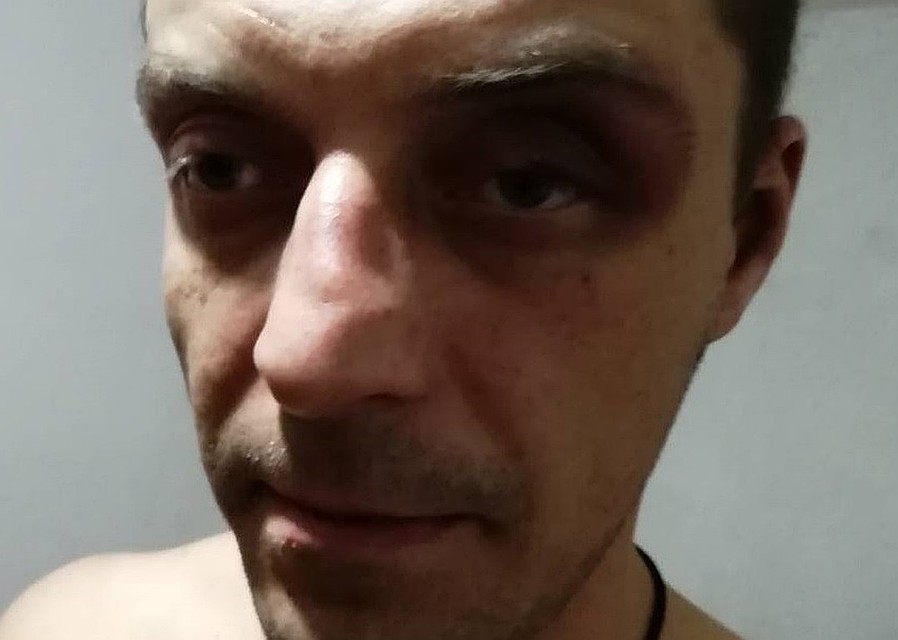 Сразу после избиения Максим зафиксировал побои. Фото: предоставлено пострадавшим