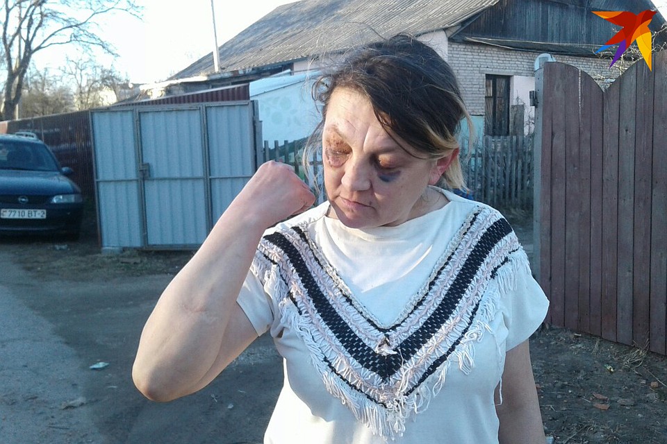 У Светланы все руки в шрамах от собачьих укусов - поэтому, объясняет женщина, она и боится незнакомых собак. Фото: Наталья ПАРТОЛИНА