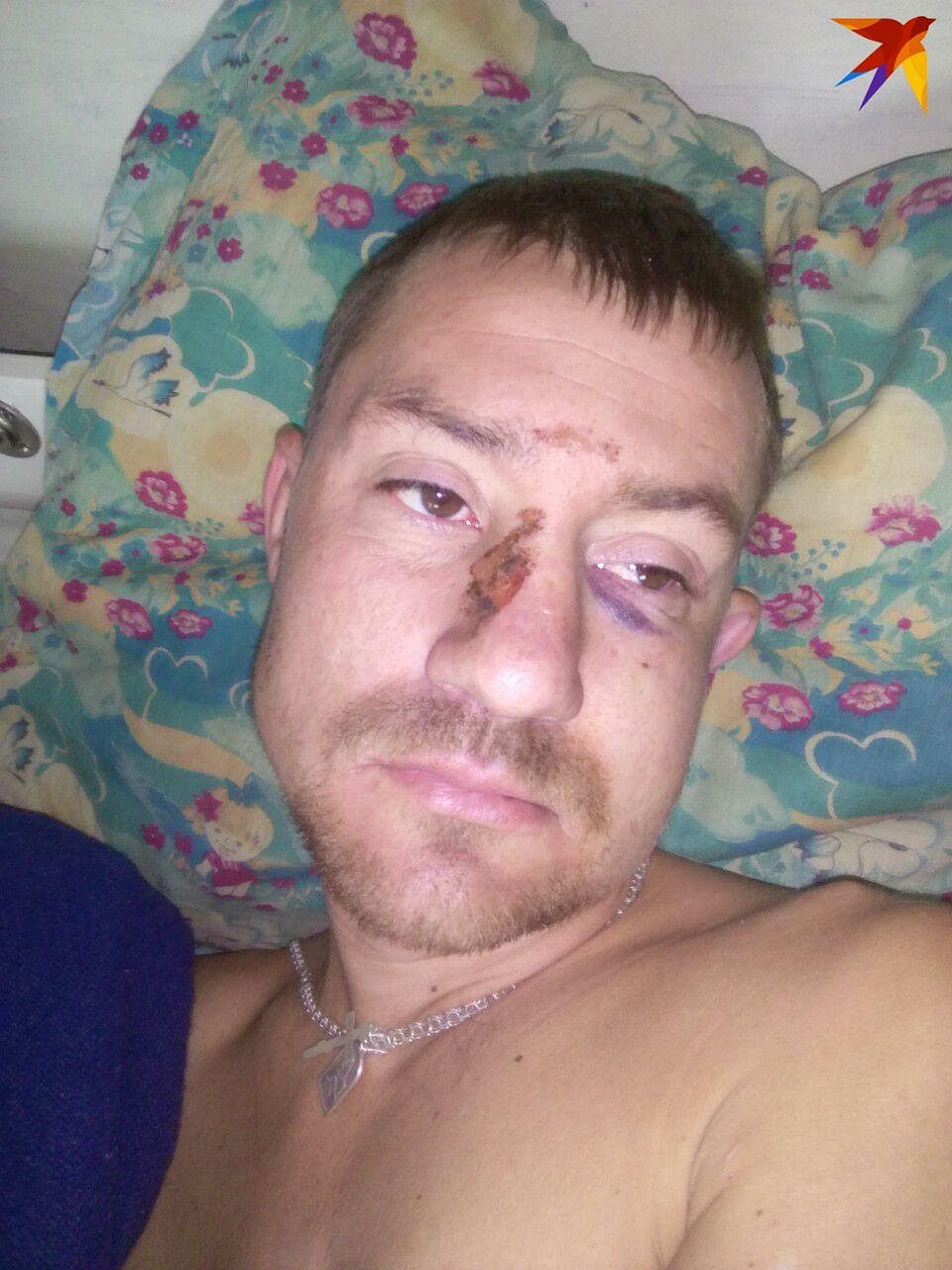 Дмитрия жестоко избили, но по сравнению с Романом Малышевым, он "легко отделался"
