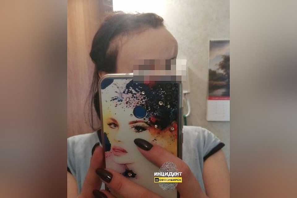 У девушки после потасовки с мужчиной образовалась на лбу здоровая шишка.
