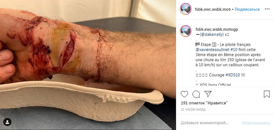 Ксавье де Сультре порезал руку до мяса. Фото: instagram.com