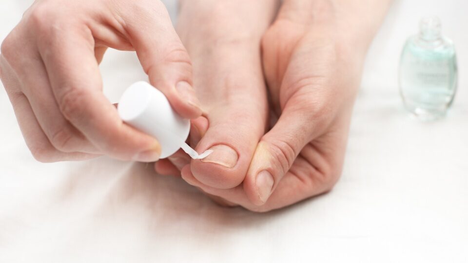 6 лучших лаков от грибка ногтей на ногах